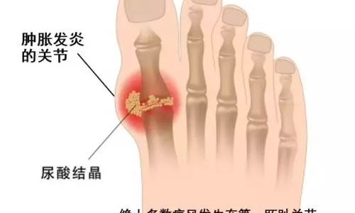 冠心病人可以跑马拉松吗网 - 为你提供冠心病可以跑步吗晨跑到底好不好、冠心病人可以慢跑么